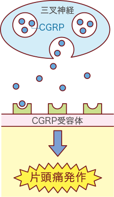 画像：片頭痛発作が起こっているときのイメージ図